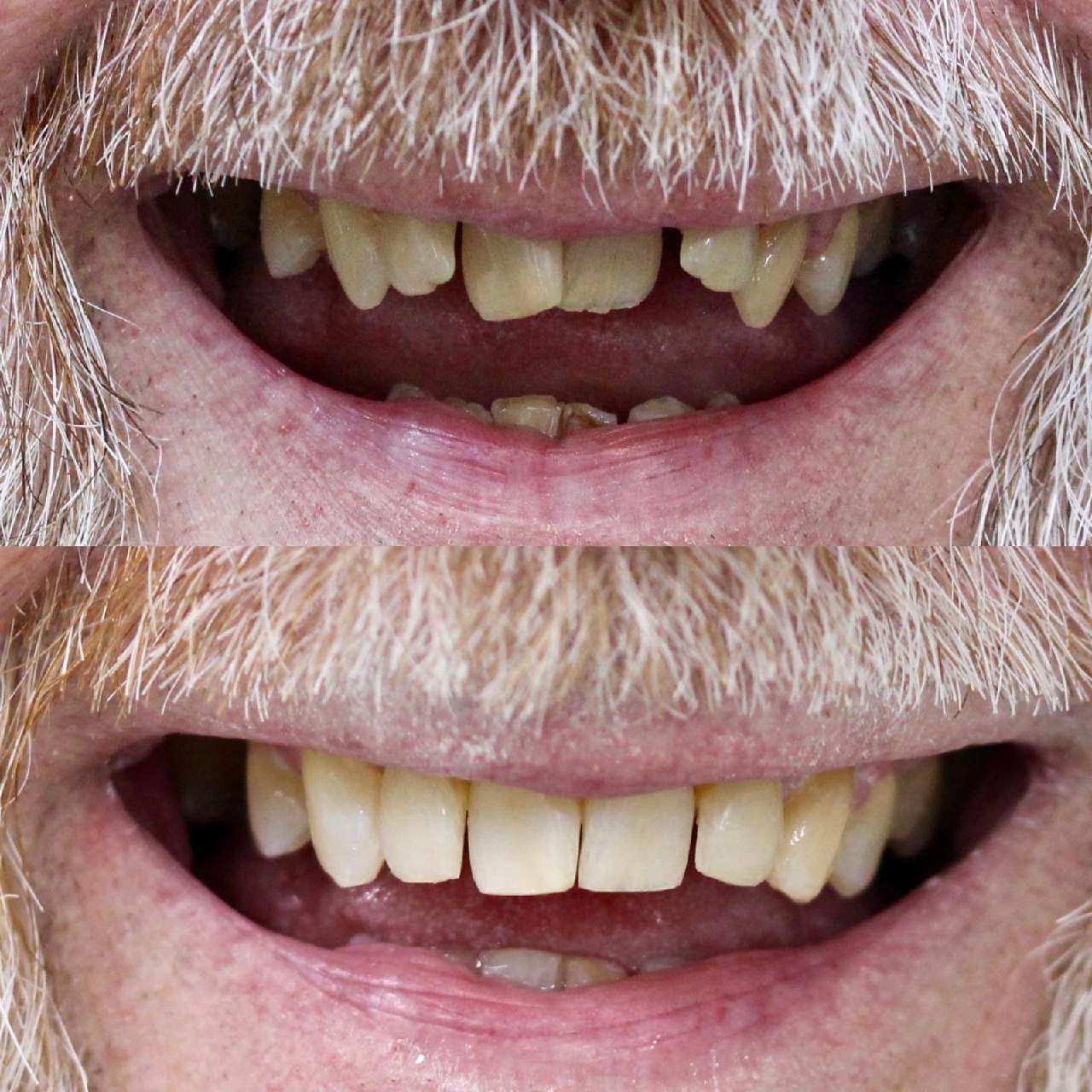Before and after full mouth restoration by Dr Jasleen Sandhu