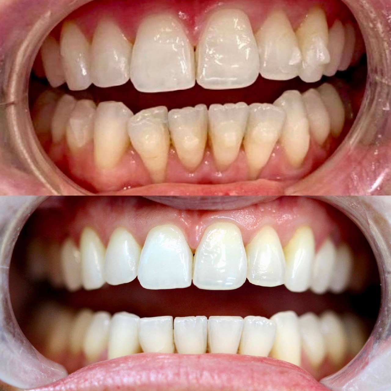 Before and after teeth alignment by Dr Jasleen Sandhu Bournemouth