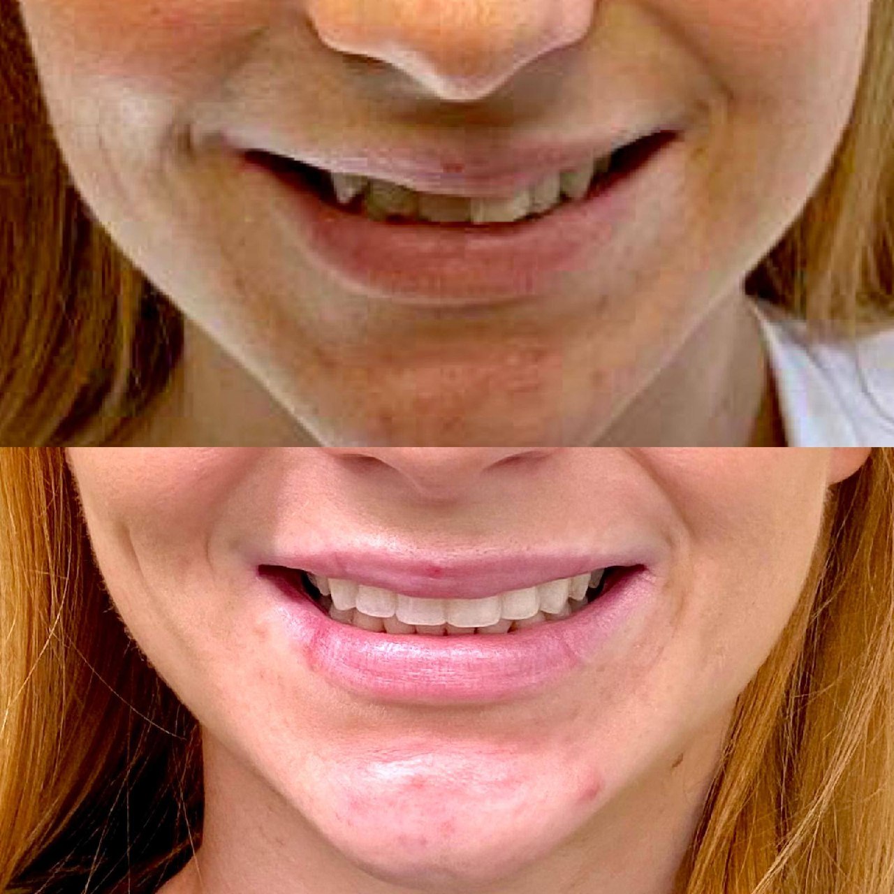 Before and after smile makeover Bournemouth dentist