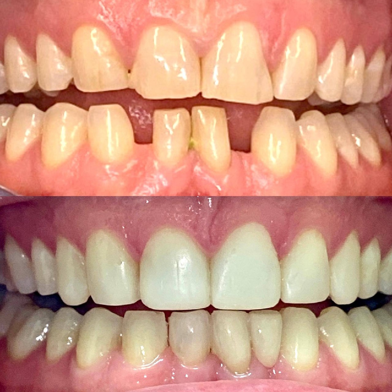 Before and after full smile makeover Invisalign Bournemouth